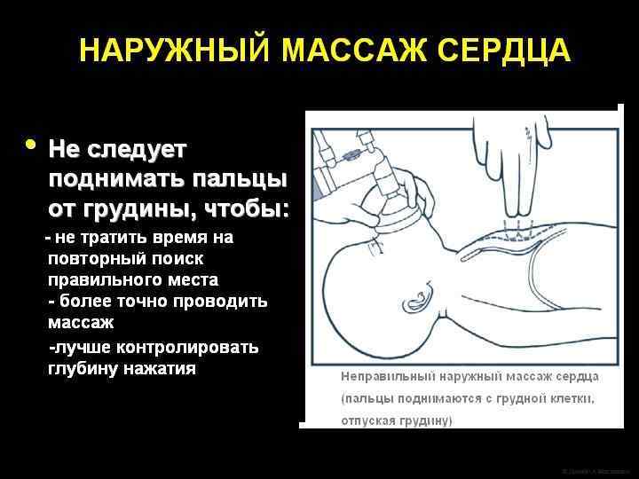 Какое оборудование должно быть под рукой? Набор для катетеризации пупочных сосудов l Стерильные перчатки