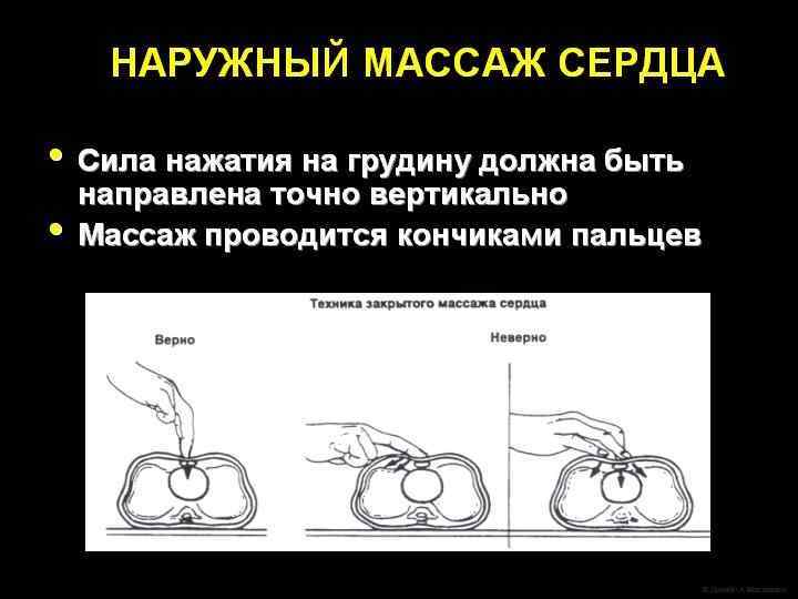 Начальные этапы первичной реанимации l l Обеспечение теплой и сухой среды Придание правильного положения