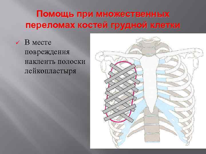 Помощь при множественных переломах костей грудной клетки ü В месте повреждения наклеить полоски лейкопластыря