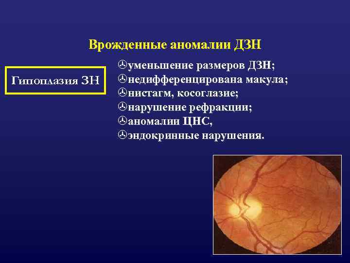 Врожденные аномалии ДЗН Гипоплазия ЗН >уменьшение размеров ДЗН; >недифференцирована макула; >нистагм, косоглазие; >нарушение рефракции;