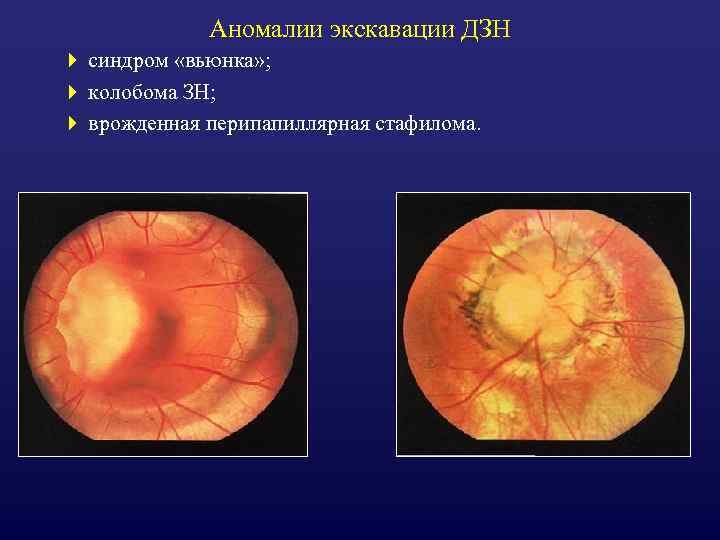 Аномалии экскавации ДЗН 4 синдром «вьюнка» ; 4 колобома ЗН; 4 врожденная перипапиллярная стафилома.