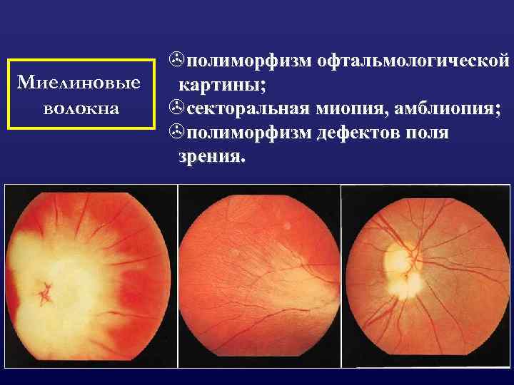 Миелиновые волокна >полиморфизм офтальмологической картины; >секторальная миопия, амблиопия; >полиморфизм дефектов поля зрения. 