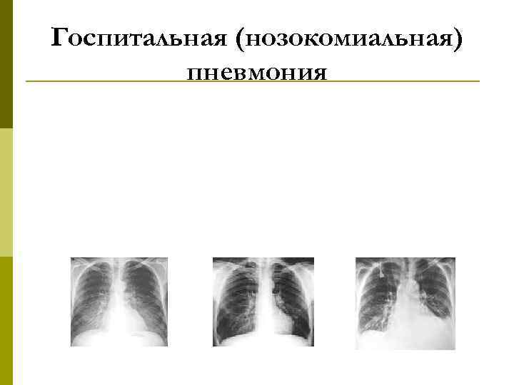 Нозокомиальная пневмония. Внутрибольничная пневмония рентген. Госпитальная пневмония рентгенограмма. Госпитальная пневмония рентген. Нозокомиальная пневмония рентген.