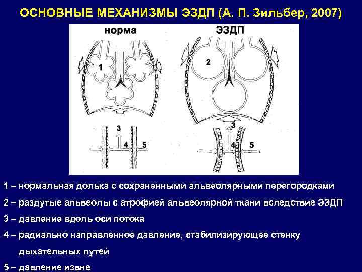 ОСНОВНЫЕ МЕХАНИЗМЫ ЭЗДП (А. П. Зильбер, 2007) 1 – нормальная долька с сохраненными альвеолярными