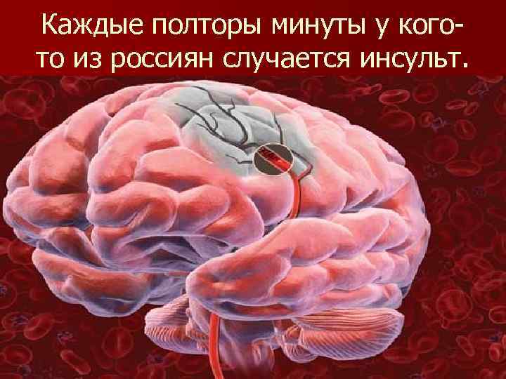 Каждые полторы минуты у когото из россиян случается инсульт. 