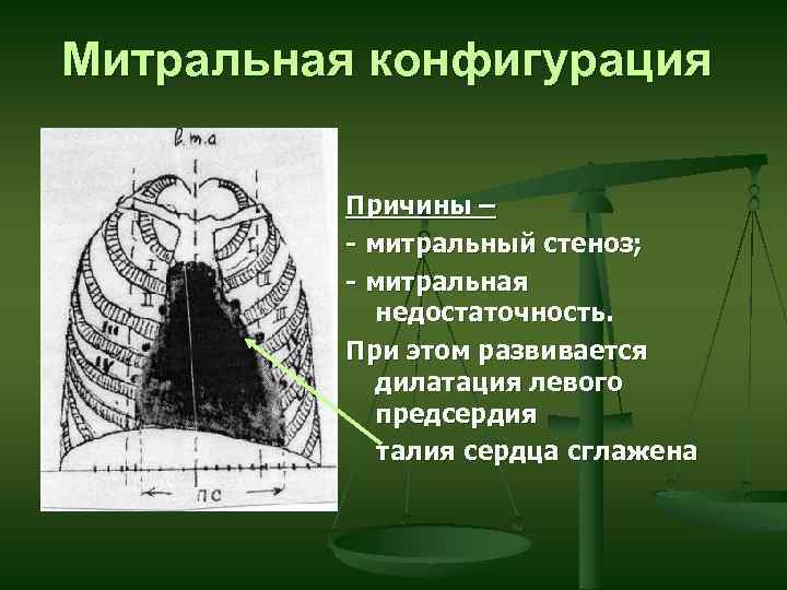 Митральное сердце