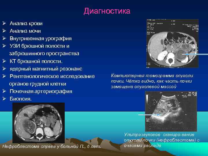 Диагностика Анализ крови Анализ мочи Внутривенная урография УЗИ брюшной полости и забрюшинного пространства КТ