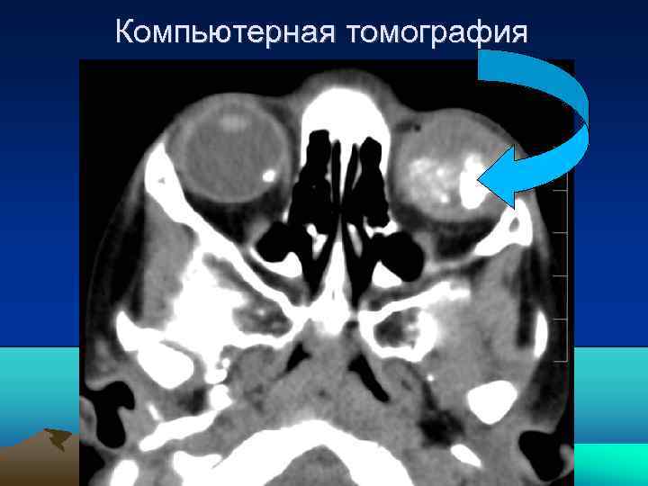 Компьютерная томография 