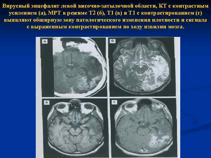 Вирусный энцефалит левой височно-затылочной области, КТ с контрастным усилением (а), МРТ в режиме Т
