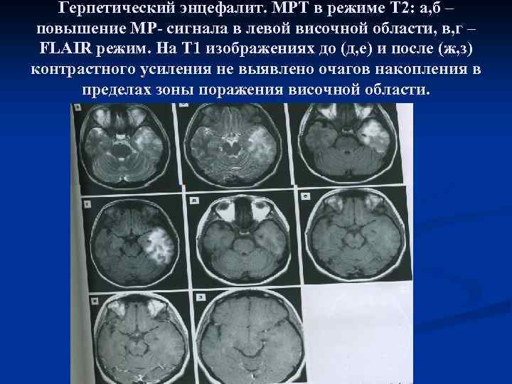Энцефалит головного мозга у взрослых. Герпетический энцефалит кт головного мозга. Гриппозный энцефалит мрт. Герпетический энцефалит мрт головного мозга.