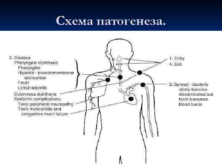 Схема патогенеза. 