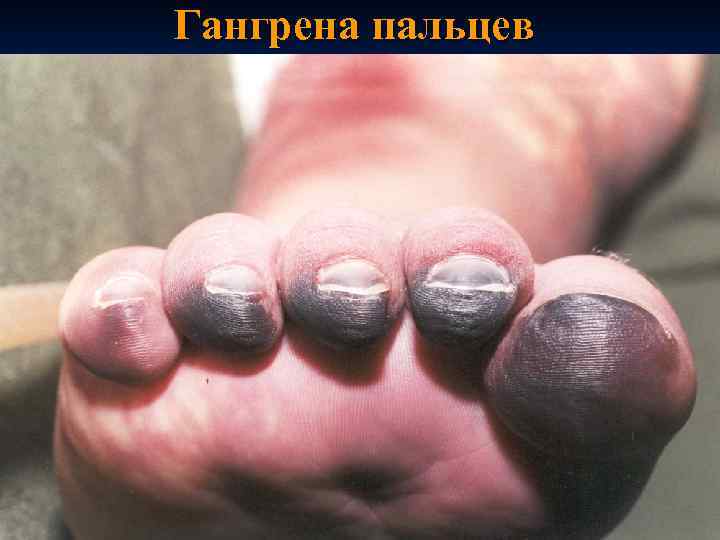Гангрена пальцев 