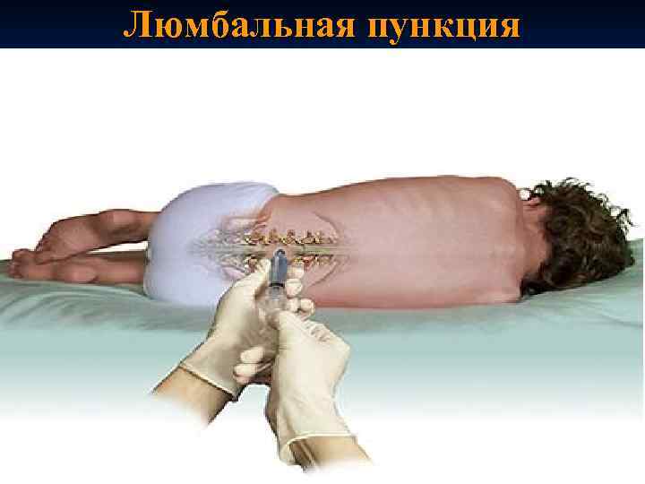 Люмбальная пункция 