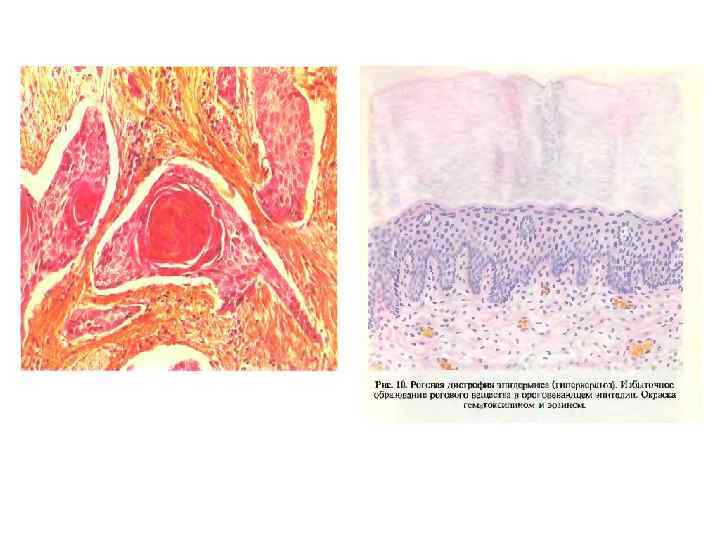 Плоскоклеточный рак с ороговением 