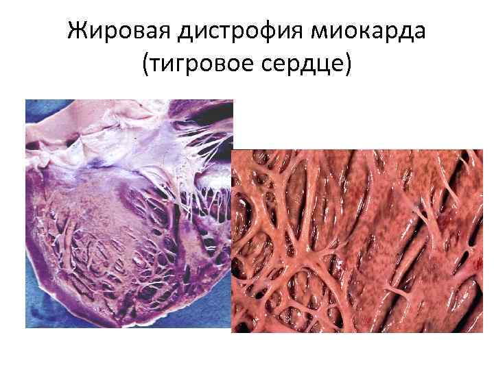 Жировая дистрофия миокарда (тигровое сердце) 