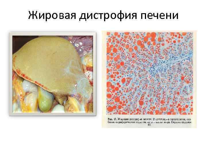 Жировая дистрофия печени Б – судан-3 
