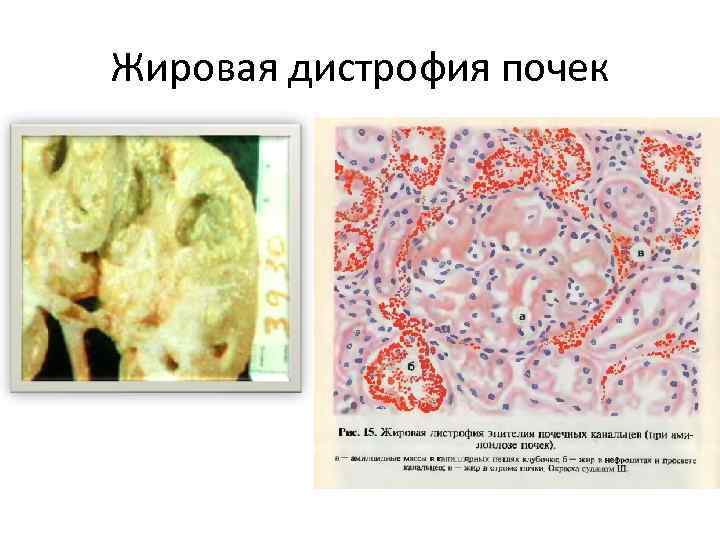 Жировая дистрофия почек 