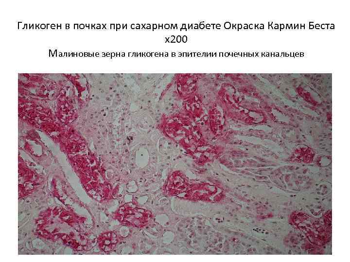 Гликоген в почках при сахарном диабете Окраска Кармин Беста х200 Малиновые зерна гликогена в
