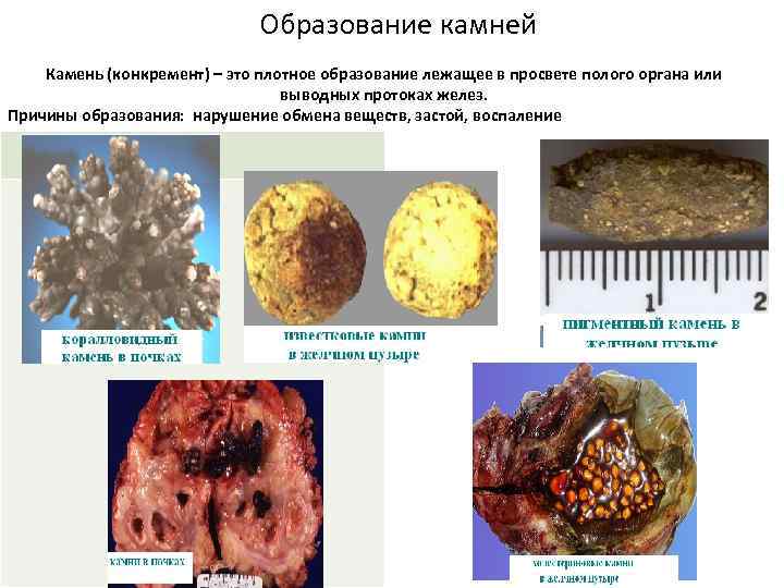 Образование камней Камень (конкремент) – это плотное образование лежащее в просвете полого органа или