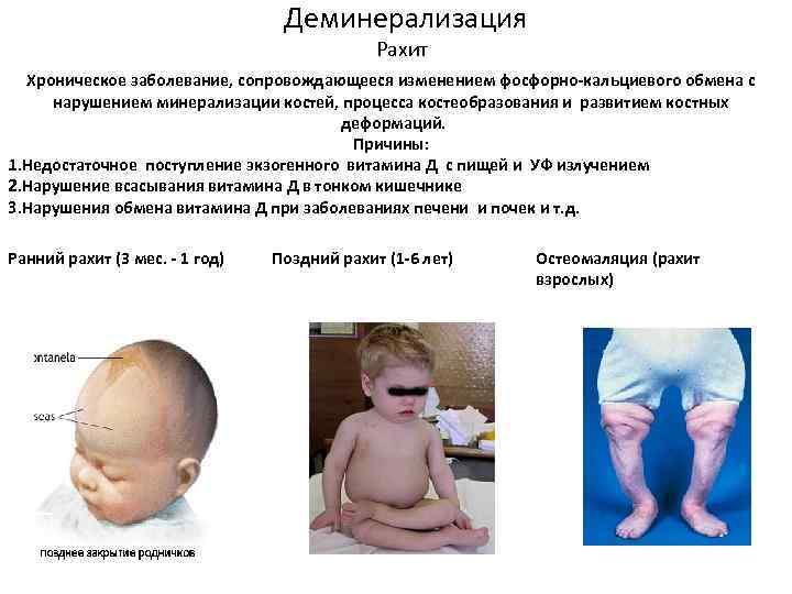 Деминерализация Рахит Хроническое заболевание, сопровождающееся изменением фосфорно-кальциевого обмена с нарушением минерализации костей, процесса костеобразования