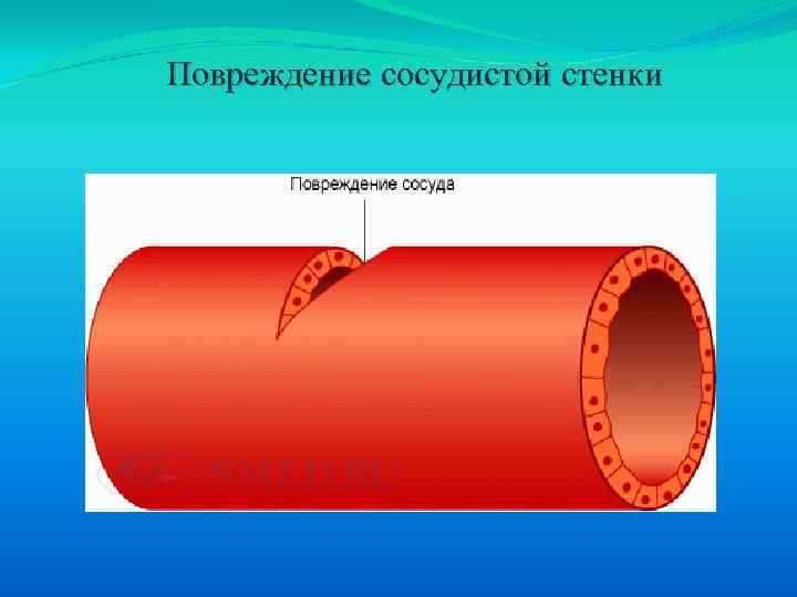 Какой сосуд поврежден на рисунке 2