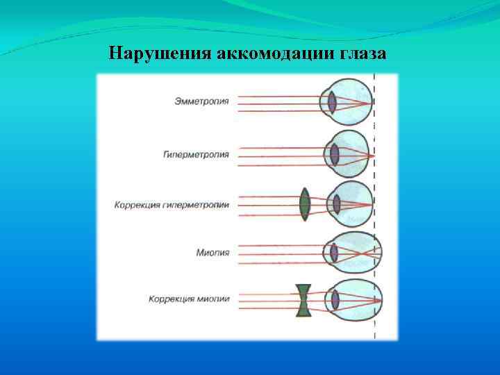 Нарушения аккомодации глаза 