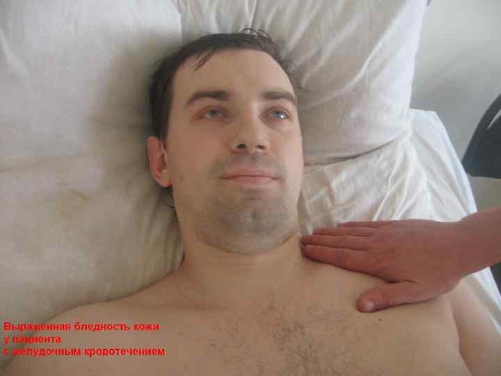 СИМПТОМАТИКА КРОВОТЕЧЕНИЯ В ЗАВИСИМОСТИ ОТ ИСТОЧНИКА СИМПТОМ  ВЕРХНИЙ ОТДЕЛ   СРЕДНИЙ ОТДЕЛ