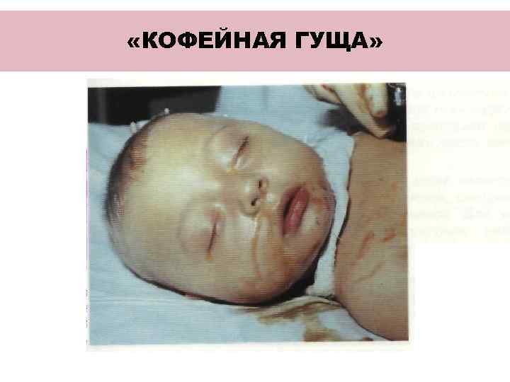  УХОД ПРИ КРОВОТЕЧЕНИИ • ИНФОРМИРОВАТЬ ВРАЧА (ХИРУРГА)  • СТРОГИЙ ПОСТЕЛЬНЫЙ РЕЖИМ 