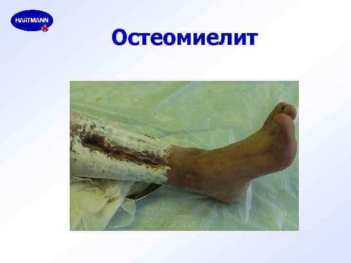 Остеомиелит 