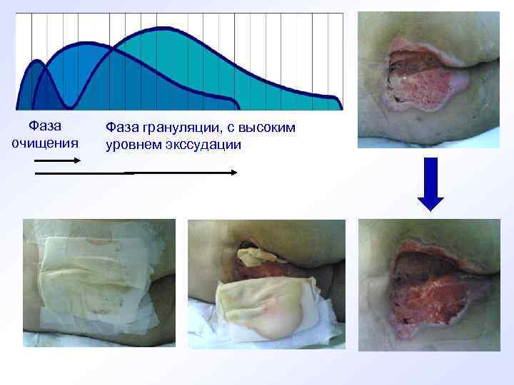 Фаза очищения Фаза грануляции, с высоким уровнем экссудации 