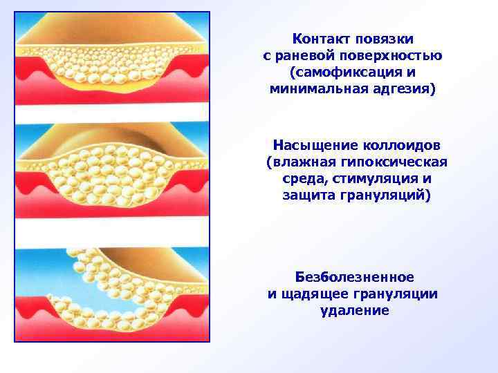 Контакт повязки с раневой поверхностью (самофиксация и минимальная адгезия) Насыщение коллоидов (влажная гипоксическая среда,