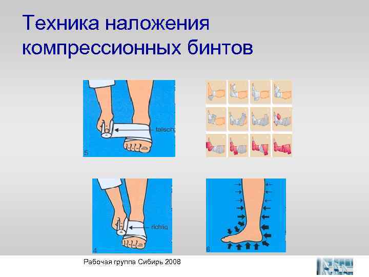 Техника наложения компрессионных бинтов Рабочая группа Сибирь 2008 