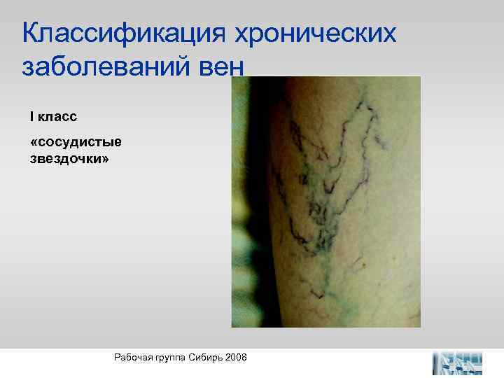 Классификация хронических заболеваний вен I класс «сосудистые звездочки» Рабочая группа Сибирь 2008 