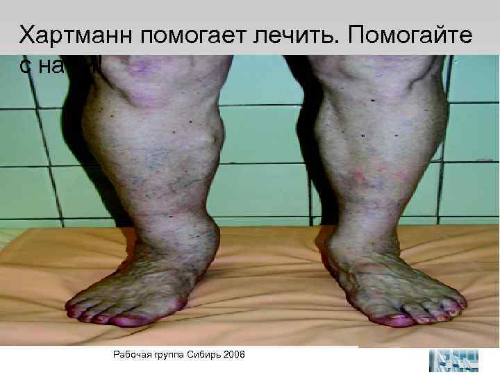 Хартманн помогает лечить. Помогайте с нами! 25. Mai 2004 Рабочая группа Сибирь 2008 