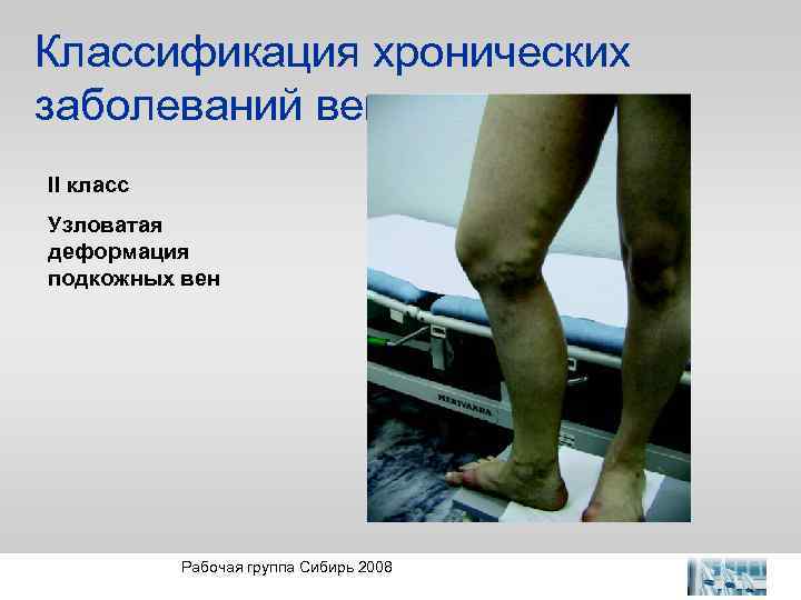 Классификация хронических заболеваний вен II класс Узловатая деформация подкожных вен Рабочая группа Сибирь 2008