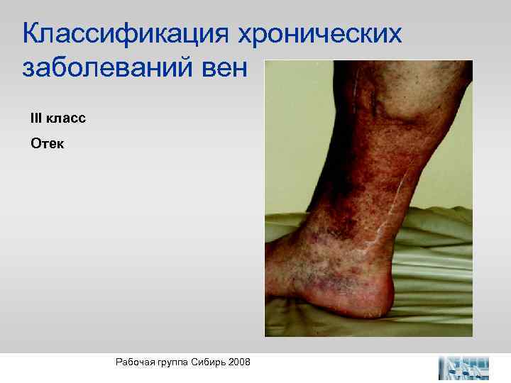 Классификация хронических заболеваний вен III класс Отек Рабочая группа Сибирь 2008 