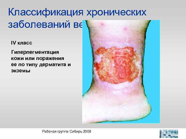 Классификация хронических заболеваний вен IV класс Гиперпегментация кожи или поражения ее по типу дерматита