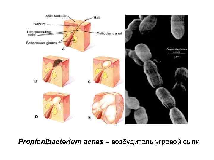 Propionibacterium acnes – возбудитель угревой сыпи 