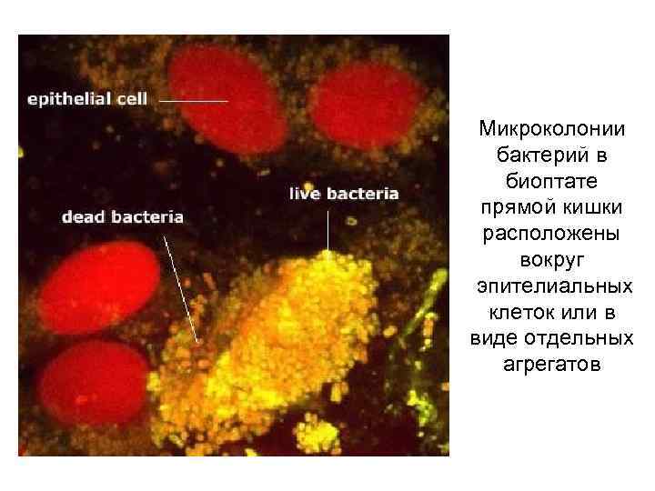 Микроколонии бактерий в биоптате прямой кишки расположены вокруг эпителиальных клеток или в виде отдельных