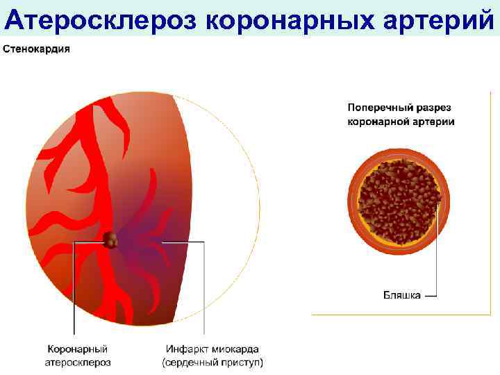 Атеросклероз коронарных артерий 