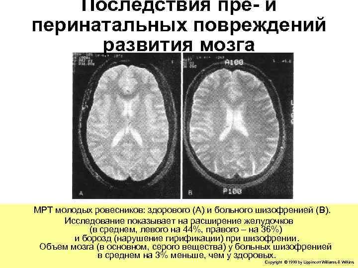  Последствия пре- и перинатальных повреждений развития мозга МРТ молодых ровесников: здорового (А) и