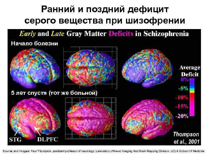  Ранний и поздний дефицит серого вещества при шизофрении Начало болезни 5 лет спустя