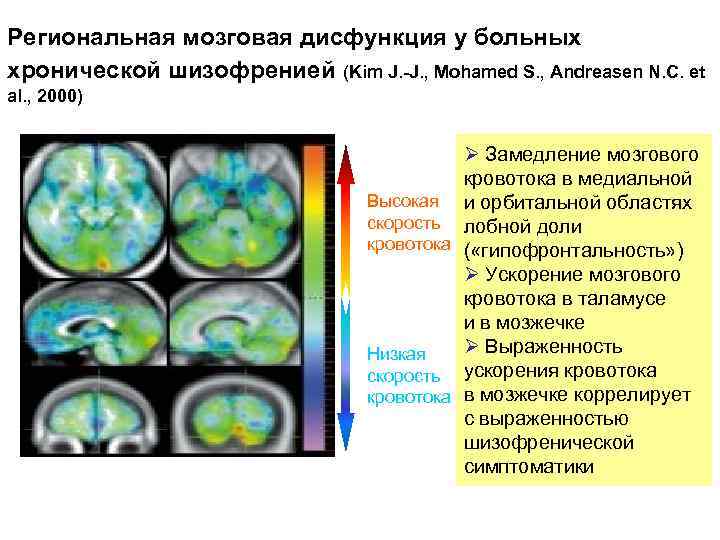 Функциональное нарушение мозга. Шизофрения изменения в мозге. Дисфункция головного мозга. Снимок мрт при шизофрении.