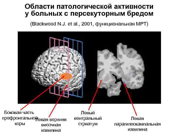  Области патологической активности у больных с персекуторным бредом (Blackwood N. J. et al.