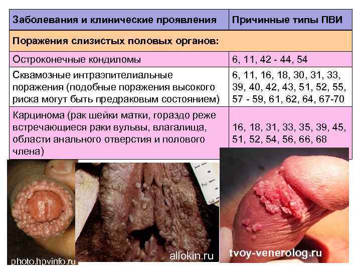 Заболевания и клинические проявления Причинные типы ПВИ Поражения слизистых половых органов: Остроконечные кондиломы 6,