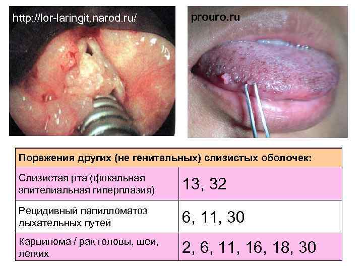 http: //lor-laringit. narod. ru/ prouro. ru Поражения других (не генитальных) слизистых оболочек: Слизистая рта