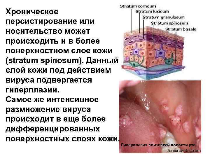 Хроническое персистирование или носительство может происходить и в более поверхностном слое кожи (stratum spinosum).