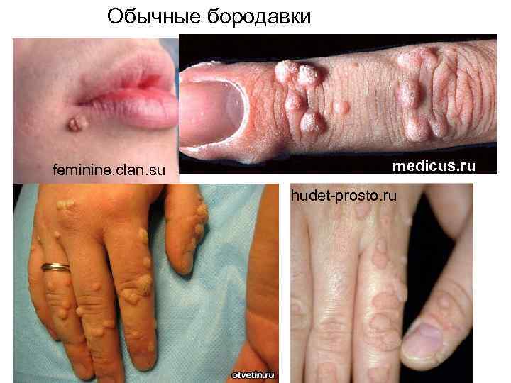 Обычные бородавки feminine. clan. su medicus. ru hudet-prosto. ru 