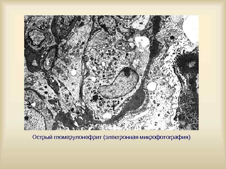 Острый гломерулонефрит (электронная микрофотография) 