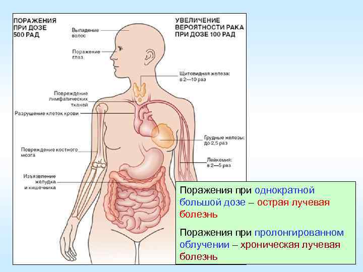 Поражения при однократной большой дозе – острая лучевая болезнь Поражения при пролонгированном облучении –